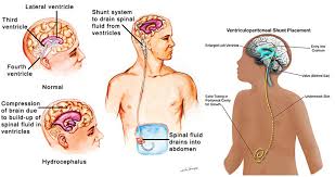 Pin By Katherine Hayward On Hydrocephalus Awareness Spina Bifida Vp Shunt Spina Bifida Facts