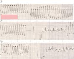 Image result for Synchronized Cardioversion