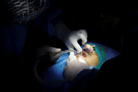 En las últimas horas se registró en uruguay un caso de mucormicosis u hongo negro, una rara infección que comenzó a reportarse en la india y que genera preocupación e incertidumbre porque se la asocia a pacientes que atraviesan un cuadro grave de coronavirus y tienen el sistema inmunológico debilitado.el caso confirmado en el país vecino afecta a un hombre de montevideo, menor de. Xtdkunzg3nqdnm