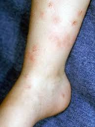Bites That Look Like Mosquito Bites Pin By Kayte Kostinden On Mosquito Bites Remedy In 2020 Remedies For Mosquito Bites Treatment For Mosquito Bites Bites On Skin