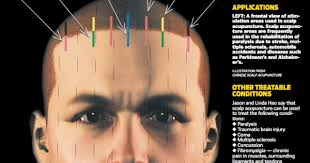 Two Santa Fe doctors, successful at treating patients with scalp  acupuncture, champion Chinese technique in new book