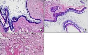 A B Epidermal Inclusion Cyst Lined By Cornified Epithelium With Download Scientific Diagram