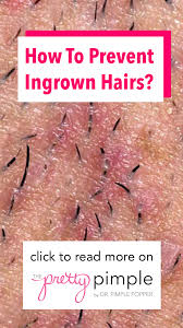 Majority of the men get ingrown hairs that develop into small clusters of ingrown may be harmless but some tend to get out of control, which in turn leads to skin discoloration and some kind of scarring. Ever Dread Shaving Worried About Getting Those Red Itchy Bumps Ingrown Hairs Develop When Hairs Curl U Ingrown Hair Ingrown Hair Bump Ingrown Hair Bikini