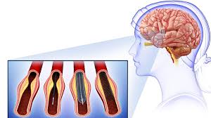 See how nerve renew can help. The Novel Coronavirus Could Attack The Central Nervous System Cgtn