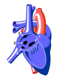 Image result for Atrial Septal Defect