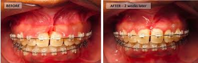Check spelling or type a new query. What Is A Frenectomy And Why Is It Necessary Jefferson Dental Orthodontics