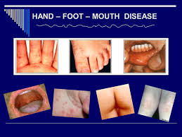 There is no vaccine that can protect us from the what are the symptoms of hand foot and mouth disease? Hand Foot Mouth Disease Ppt Video Online Download