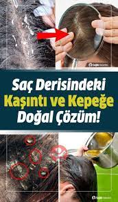 Sac Derisinde Kizariklik Ve Kasintisi Neden Olur Ne Iyi Gelir Nasil Gecer Scalp Rash Skin Redness Redness