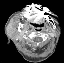 Image result for Sialolithiasis