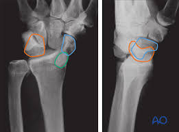 Image result for Lunate Dislocation
