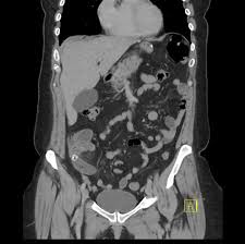 Acute Appendicitis Radiology Case Radiopaedia Org Articles, cases, courses and more. acute appendicitis radiology case