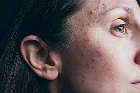 Image result for acne face
