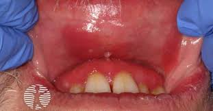 Image result for Erythroplakia roof of mouth