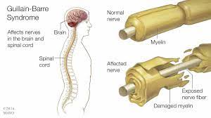 But two types of treatments can speed recovery and reduce the severity of the illness: Guillain Barre Rolmodel