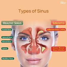 Image result for Sinusitis Prediction Rule