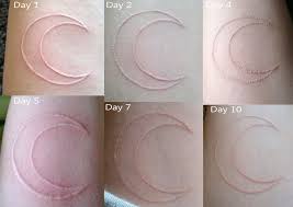 Red tattoo removal on black skin. The Darkest Of Lights White Ink Tattoos Healed White Ink Tattoo Healing Tattoo