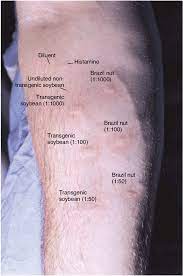 Reactivity On Skin Prick Testing To Extracts Of Transgenic Soybean Download Scientific Diagram