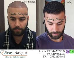 Hasson have helped people from more than 70 countries. Hair Transplant Uk Hair Transplant Uk Hair Transplant Hair Transplant Results