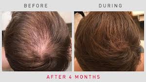 Rogaine is consistently safe in men and can cure hair loss over 50% of cases (1). Before After Photos Laser Hair Growth Therapy Irestore Reviews Irestore Hair Growth System