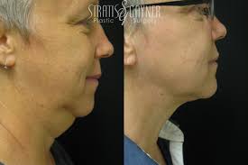 Facial Liposuction for Harrisburg & Lancaster, PA
