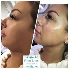 Results & reviews — Finer Lines Aesthetics