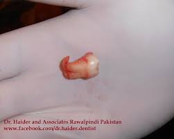File J Roots Of Mandibular Wisdom Tooth Jpg Wikimedia Commons