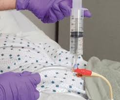 Image result for Bladder Irrigation