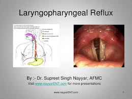 Lpr Laryngopharyngeal Reflux Laryngopharyngeal Reflux Laryngopharyngeal Reflux Disease Reflux