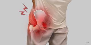 Image result for Hip Labral Tear