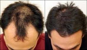 Biotin Hair Growth Results Before And After Biotin Gold Hair Growth Results Before After Hair Loss Solutions Hair Implants Hair Transplant Surgery