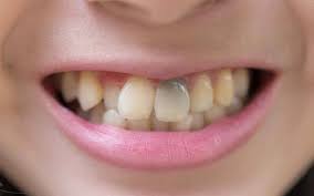 Image result for Tooth Discoloration