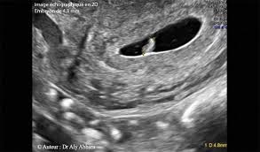 Aucun des signes prouvant une grossesse n'est encore perceptible. Anatomie Echographique D Une Grossesse De 6 Sa