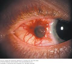 Image result for lesion sclera