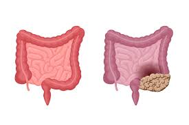 The abdominal cavity is the part of the body that houses the stomach, liver, pancreas, kidneys, gallbladder, spleen, and the large and small intestines.the diaphragm marks the top of the abdomen and the horizontal line at the level of the top of the pelvis marks the bottom. Human Intestines Anatomy Strong Healthy And Unhealthy With Colon Cancer Comparison Abdominal Cavity Digestive And Excretory Internal Organ Oncology Tumor Vector Digestion Problem Eps Illustration 2292631 Vector Art At Vecteezy