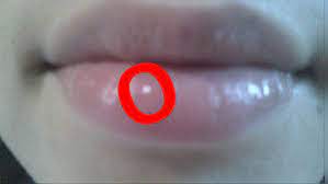 Übt man vonn innen druck mit der zunge suf die lippe aus, ist der knoten nicht durchblutet. Ich Hab Einen Buckel Auf Unterlippe Lippe Knoten