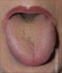 black coated tongue in integrative medicine an alarm signal