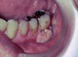 It will show the normal anatomy of the bone and the additional growth arising from the bone and we can see the exact dimensions of the cancer and its local extent of spread and invasion into the surrounding tissues. Oral Cancer Images The Oral Cancer Foundation