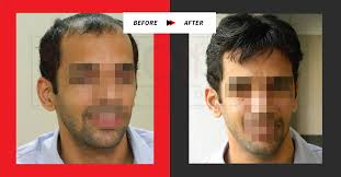 It gives u 100% natural hair look in no time. Hair Weaving And Bonding Best Hair Weaving Bonding Treatment For Men Women In Pune India Near Me Best Price Papillon Hair World