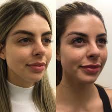 Aesthetic Nurse Michelle