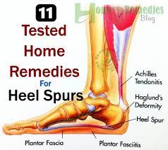 11 Tested Natural Home Remedies For Heel Spurs Home Remedies Blog Heel Spurs Heal Spur Remedies Heel Spurs Remedies
