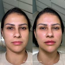 Full face com apenas 4mls!! Resultado incrível onde melhoramos alguns  traços com naturalidade, realçando a beleza e trazendo harmonia. Para mais  informações acesse o link da bio. Dra Maria Eduarda Moura CRORJ