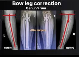 Image result for Genu Varum