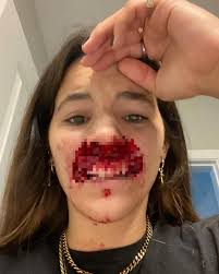 Blood warning. This photo was taken a few minutes after I was attacked. I  had no idea what I looked like, so I took out my phone to check with the  front