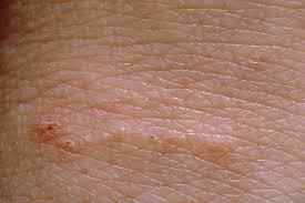 Image result for scabies human bites