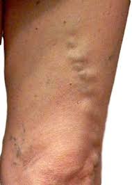 Groin pain is a common occurrence and develops from a variety of causes. Varicose Veins Leg Groin Right In Your Face
