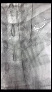 Image result for Simplified PESI