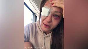 Oct 06, 1992 · yair rodriguez breaking news and and highlights for ufc fight night fight vs. Karolina Kowalkiewicz Gives Emotional Update On Her Eye Injury Youtube