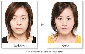 Pin On Services For Shinagawa Lasik And Aesthetics Philippines