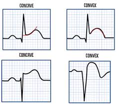 Image result for ST Elevation