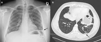Causes of an exudative effusion are malignancy, infection, or inflammatory disorders such. Rapidly Progressive Pleural Effusion Cleveland Clinic Journal Of Medicine